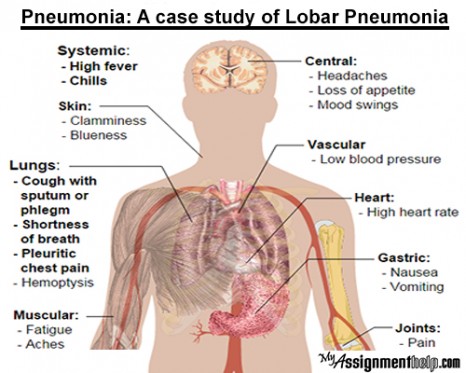 Pneumonia A Case Study of Lobar Pneumonia pic