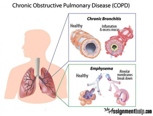 case study 21 copd with respiratory failure answers